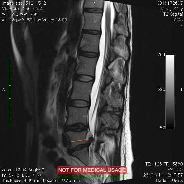 Osteoartrose Hernia_discal_e_estenose_